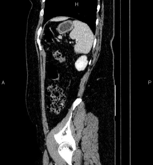 Adrenal cortical carcinoma (Radiopaedia 84882-100379 Sagittal C+ portal venous phase 73).jpg