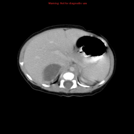 File:Adrenal hemorrhage (Radiopaedia 9390-10077 Axial C+ portal venous phase 5).jpg