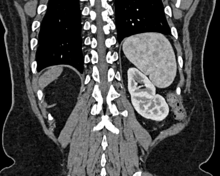 Adrenal metastases (Radiopaedia 73082-83791 Coronal C+ arterial phase 69).jpg