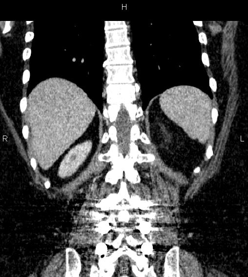 Adrenal myelolipoma (Radiopaedia 84319-99617 Coronal renal cortical phase 62).jpg