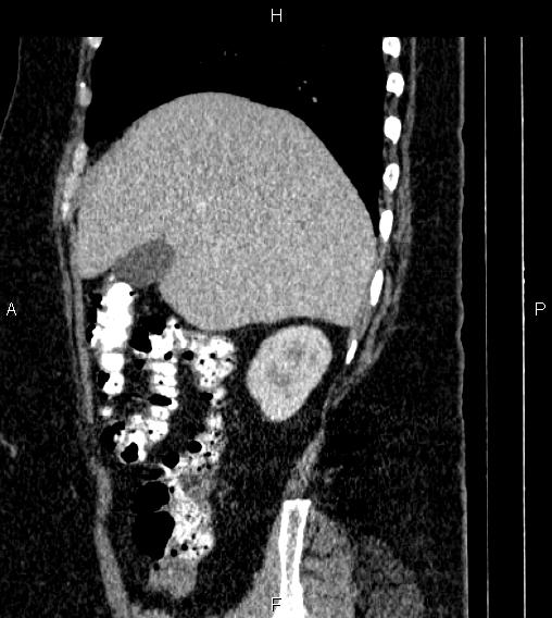 File:Adrenal myelolipoma (Radiopaedia 84319-99617 Sagittal renal cortical phase 21).jpg