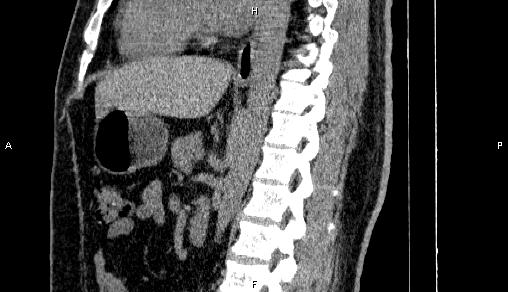 Adrenal myelolipoma (Radiopaedia 84321-99619 Sagittal non-contrast 59).jpg