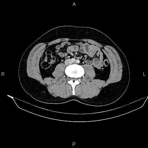 Adrenal myelolipoma (Radiopaedia 87794-104246 Axial renal cortical phase 60).jpg