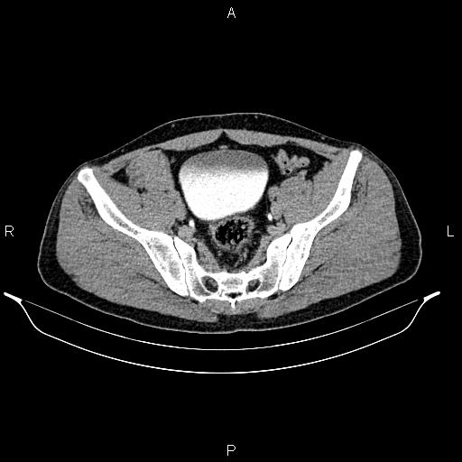 Adrenal myelolipoma (Radiopaedia 87794-104246 Axial renal excretory phase 83).jpg