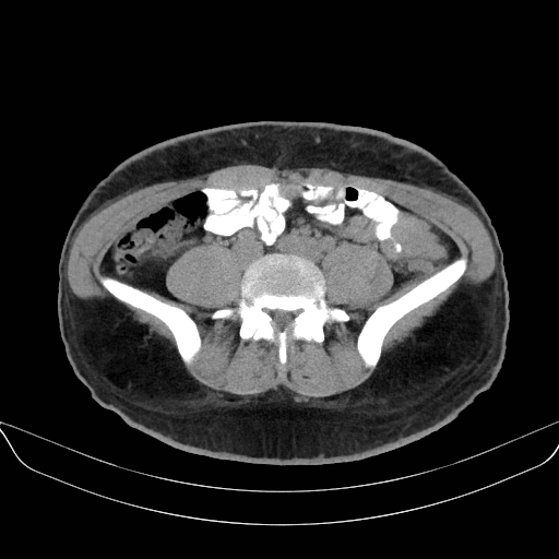 Adrenal myelolipoma - bilateral (Radiopaedia 74805-85810 Axial non-contrast 52).jpg