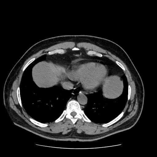 Adrenal myelolipoma and beaver tail liver (Radiopaedia 86201-102193 Axial non-contrast 24).jpg