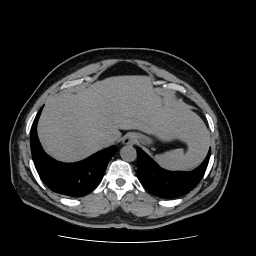 Adrenal myelolipoma and beaver tail liver (Radiopaedia 86201-102193 Axial non-contrast 61).jpg