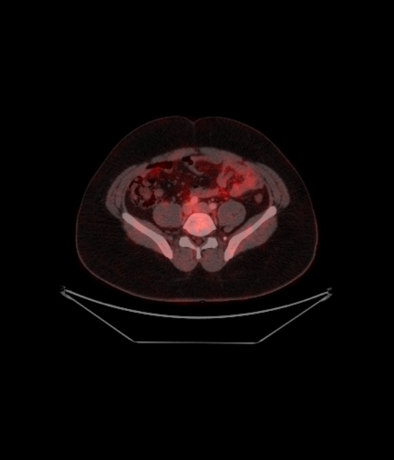 Adrenocortical carcinoma (Radiopaedia 80134-93440 ِAxial 212).jpg