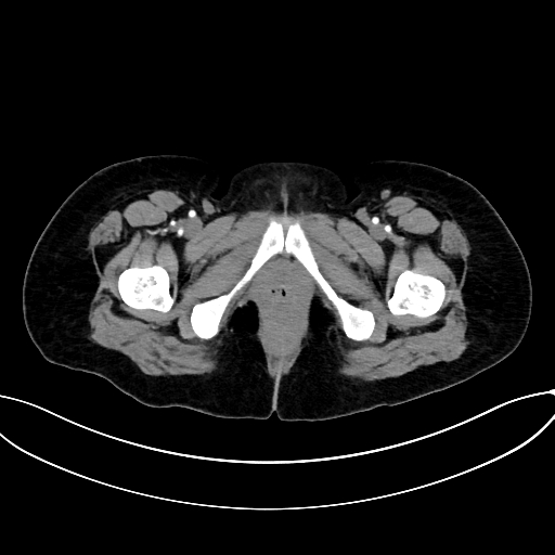 Adrenocortical carcinoma (Radiopaedia 87281-103569 Axial C+ arterial phase 92).jpg