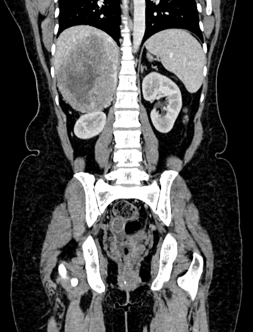Adrenocortical carcinoma (Radiopaedia 87281-103569 Coronal C+ portal venous phase 85).jpg