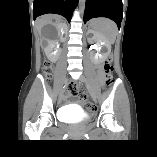 File:Adult polycystic kidney disease (Radiopaedia 48845-53876 Coronal renal excretory phase 25).jpg