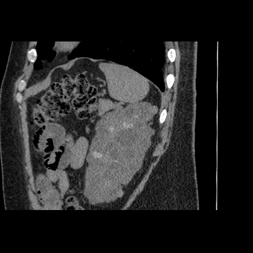 Adult polycystic kidney disease (Radiopaedia 59075-66368 Sagittal non-contrast 74).jpg