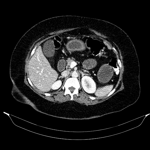 Afferent loop syndrome - secondary to incarcerated trocar site hernia (Radiopaedia 82959-97305 Axial C+ portal venous phase 79).jpg