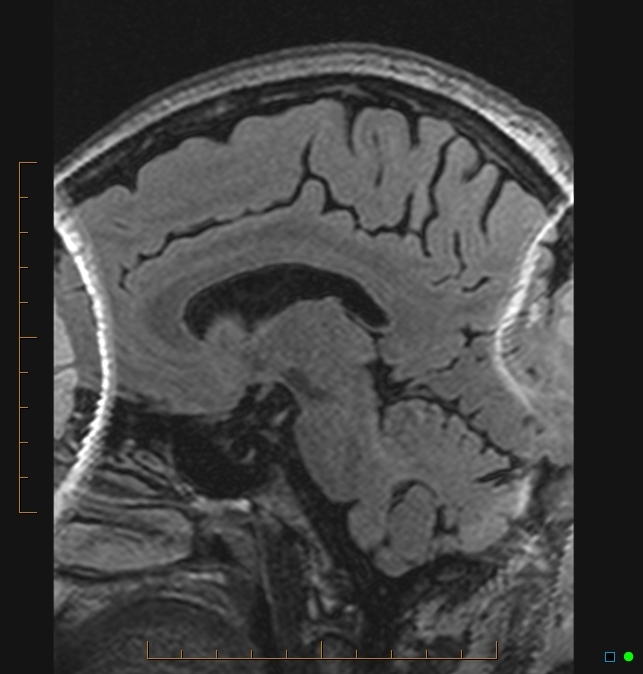 Aliasing artifact causing a spurious cerebellar lesion (Radiopaedia 48783-53810 Sagittal FLAIR 31).jpg