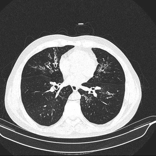 File:Allergic bronchopulmonary aspergillosis (Radiopaedia 21386-21320 Axial lung window 22).jpg
