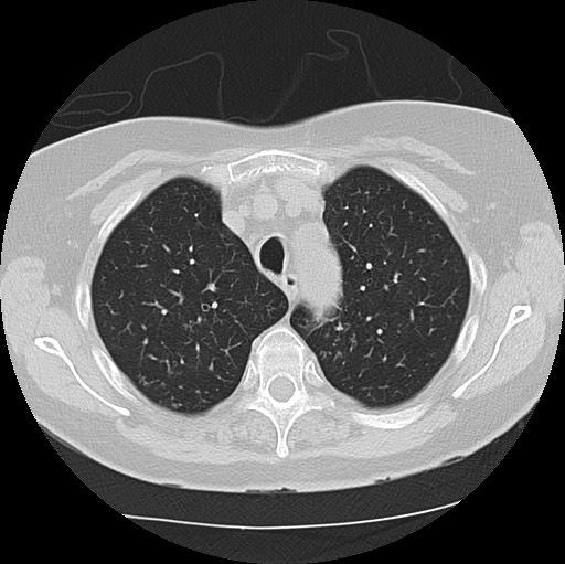 Alpha-1-antitrypsin deficiency (Radiopaedia 72058-82557 Axial lung window 15).jpg