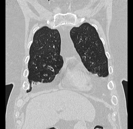 File:Alpha-1-antitrypsin deficiency (Radiopaedia 72058-82557 Coronal lung window 6).jpg