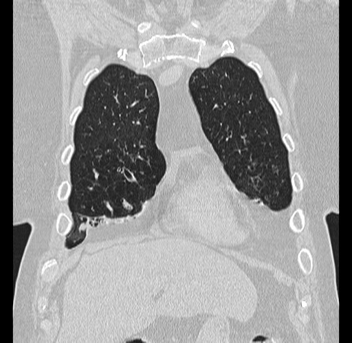 Alpha-1-antitrypsin deficiency (Radiopaedia 72058-82557 Coronal lung window 8).jpg
