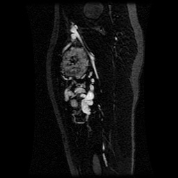 Alveolar soft part sarcoma (Radiopaedia 64501-73678 D 65).jpg
