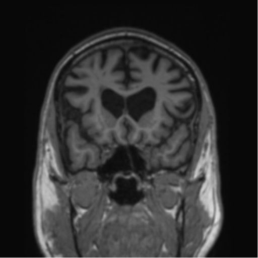 Alzheimer's disease- with Gerstmann syndrome and dressing apraxia (Radiopaedia 54882-61150 Coronal T1 61).png