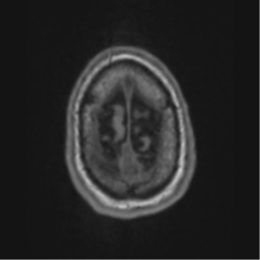 Alzheimer's disease- with apraxia (Radiopaedia 54763-61011 Axial T1 71).png