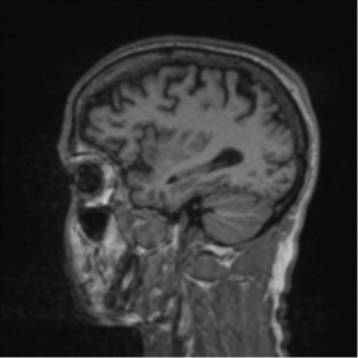 Alzheimer's disease- with apraxia (Radiopaedia 54763-61011 Sagittal T1 52).png