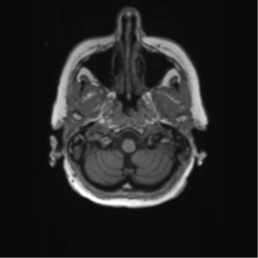 File:Alzheimer's disease (Radiopaedia 42658-45802 Axial T1 134).png