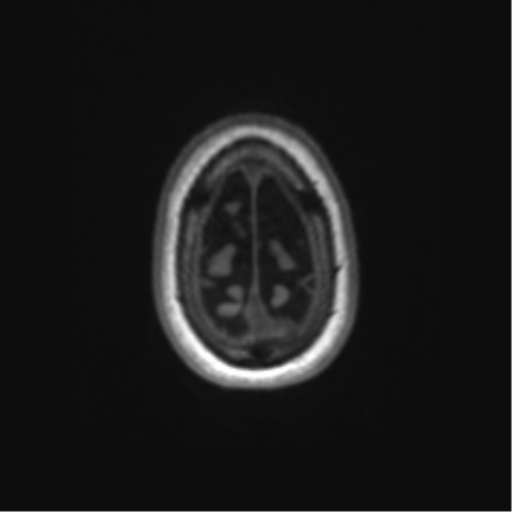 Alzheimer's disease (Radiopaedia 42658-45802 Axial T1 19).png