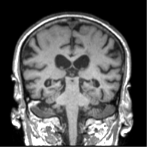 Alzheimer disease and cerebral amyloid angiopathy (Radiopaedia 64234-73011 Coronal T1 24).png