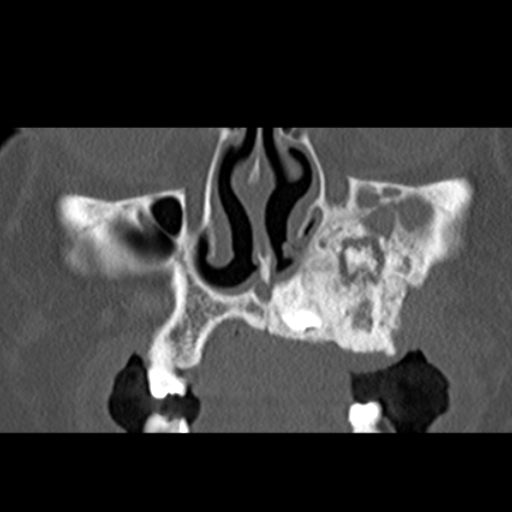 File:Ameloblastic fibro-odontoma (Radiopaedia 18843-18780 B 10).jpg