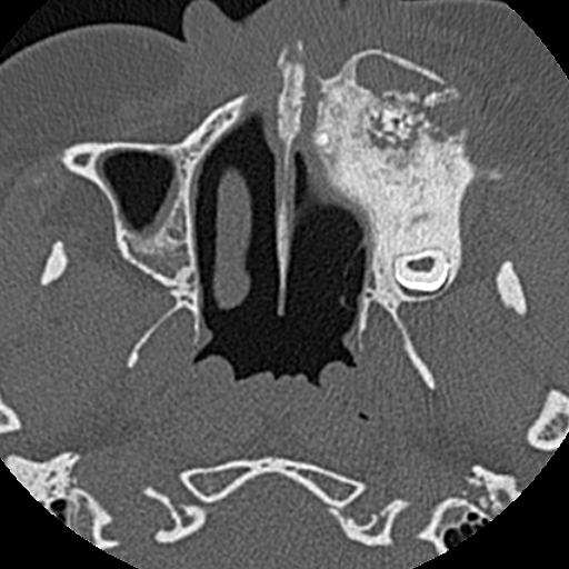 File:Ameloblastic fibro-odontoma (Radiopaedia 18843-18780 C 29).jpg