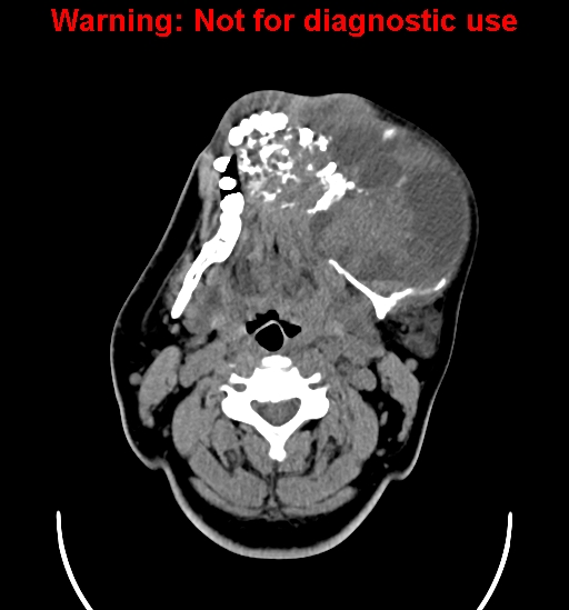 File:Ameloblastoma (Radiopaedia 33126-34164 A 11).jpg