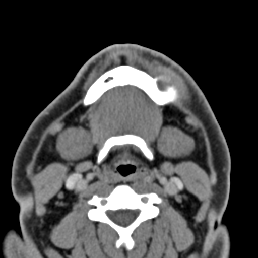 File:Ameloblastoma (Radiopaedia 33677-34806 Axial non-contrast 31).png