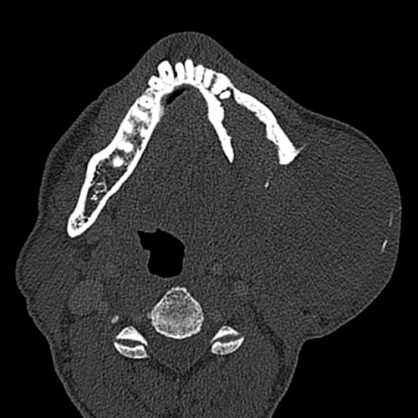 Ameloblastoma (Radiopaedia 51921-57766 Axial bone window 60).jpg