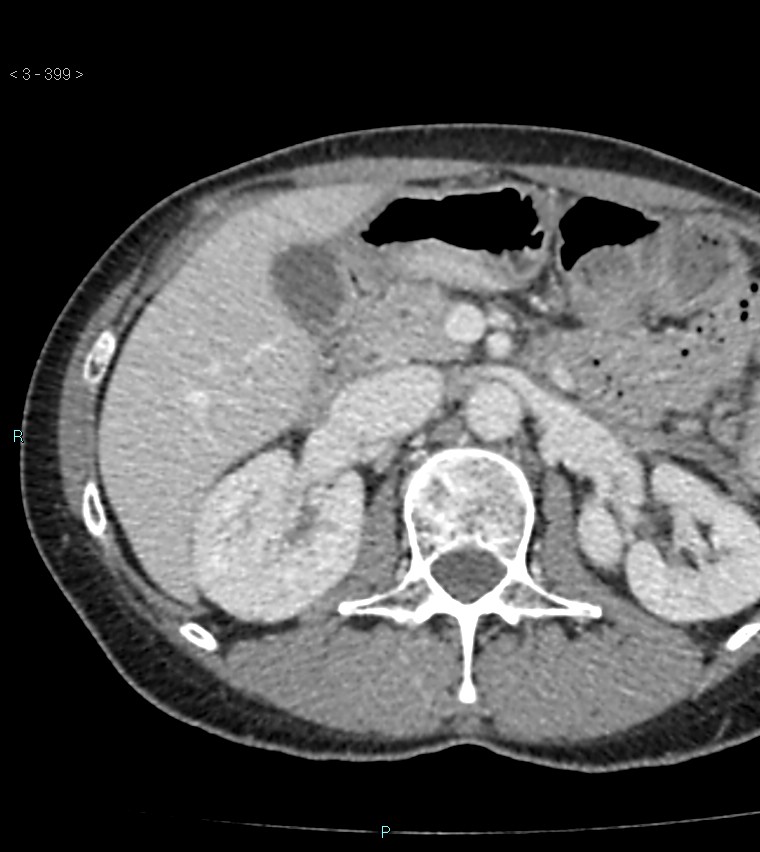 Ampulla of Vater metastasis (Radiopaedia 27820-28065 A 3).jpg