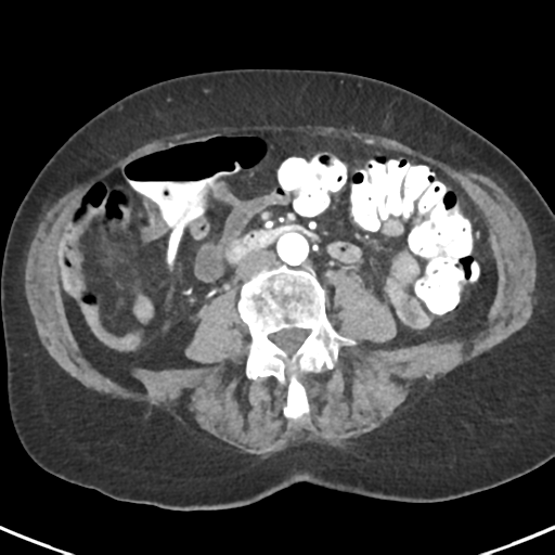 Ampullary adenocarcinoma (Radiopaedia 34013-35237 B 56).png