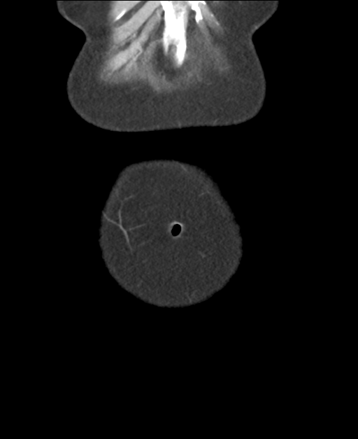 Ampullary adenocarcinoma (Radiopaedia 34013-35237 E 5).png