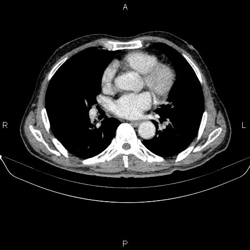 File:Ampullary adenocarcinoma (Radiopaedia 86093-102032 A 2).jpg