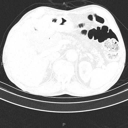 Ampullary adenocarcinoma (Radiopaedia 86093-102033 Axial lung window 56).jpg