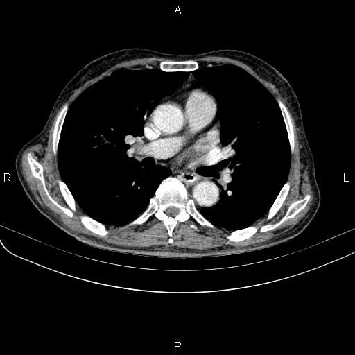 File:Ampullary adenocarcinoma (Radiopaedia 86093-102033 B 32).jpg
