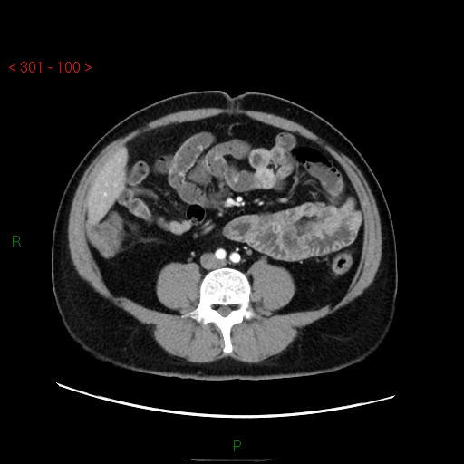 File:Ampullary carcinoma (Radiopaedia 56396-63056 B 46).jpg