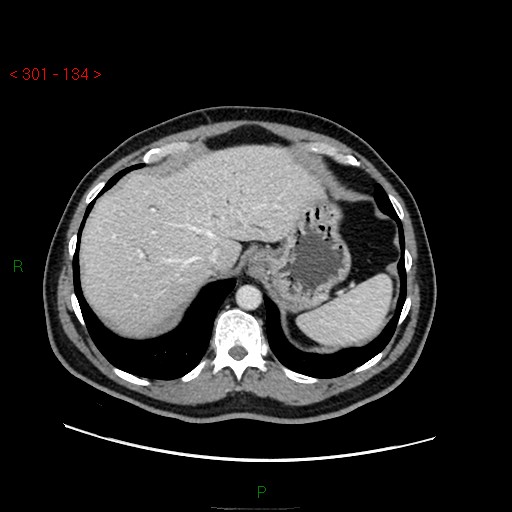 File:Ampullary carcinoma (Radiopaedia 56396-63056 C 17).jpg