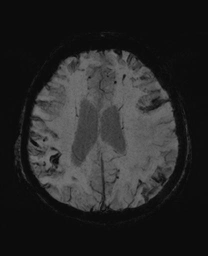 File:Amyloid angiopathy with inflammation (Radiopaedia 30360-31002 Axial SWI MIP 43).jpg