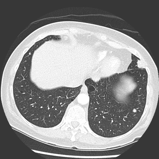 Amyloidosis - bronchial and diffuse nodular pulmonary involvement (Radiopaedia 60156-67745 Axial lung window 68).jpg