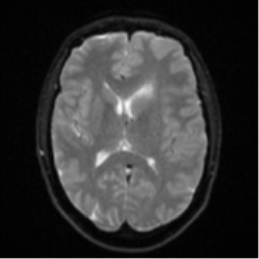 Anaplastic astrocytoma (Radiopaedia 57768-64731 Axial DWI 15).png