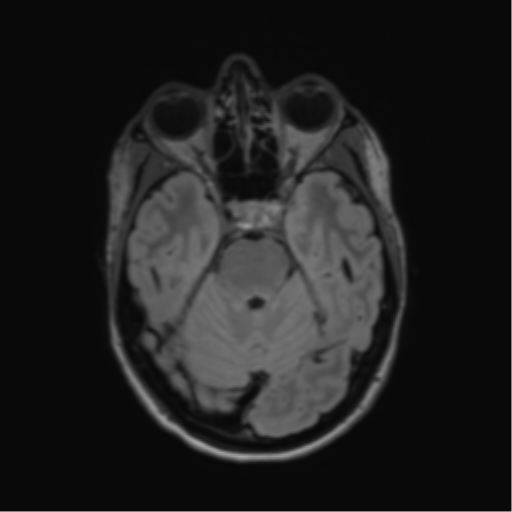 File:Anaplastic astrocytoma IDH mutant (Radiopaedia 50046-55341 Axial FLAIR 17).png