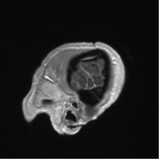 Anaplastic astrocytoma IDH mutant (Radiopaedia 50046-55341 Sagittal T1 C+ 55).png