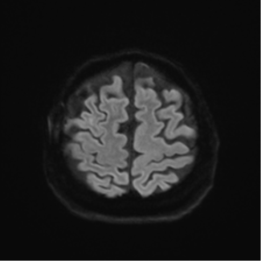Anaplastic astrocytoma IDH wild-type (pseudoprogression) (Radiopaedia 42209-45279 Axial DWI 49).png