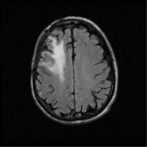 File:Anaplastic meningioma with recurrence (Radiopaedia 34452-35789 Axial FLAIR 17).png