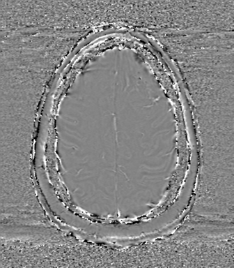 Anaplastic oligodendroglioma (Radiopaedia 83500-98599 Axial SWI - phase 68).png